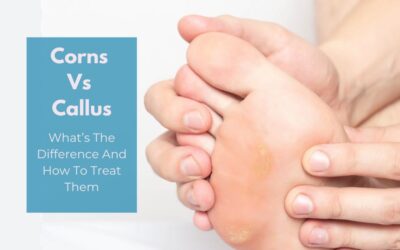 Corns Vs Callus: What’s the Difference and How to Treat Them